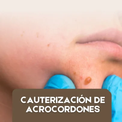 Cauterización de Acrocordones